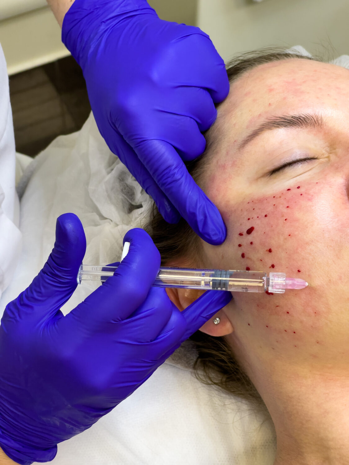 The doctor cosmetologist makes mesotherapy or biorevitalization procedure of a beautiful woman in a beauty salon. Face skin rejuvenation and contouring, mesotherapy and biorevitalization. Injection traces. Woman face in the process of biorevitalization procedure. Multiple injection marks are visible on the skin. Cosmetology skin care.